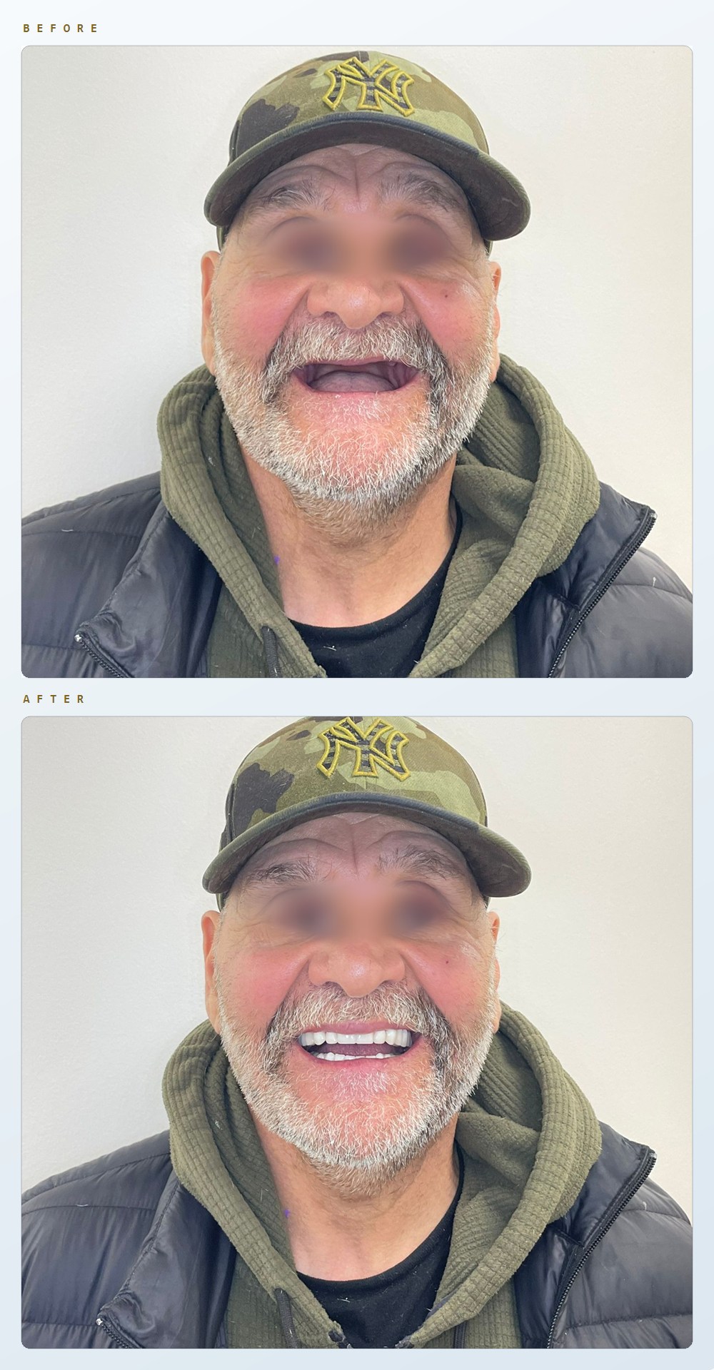 Before and after photographs of the same patient, eyes blurred: above, smiling with no upper teeth; below, smiling with a full set of denture teeth.