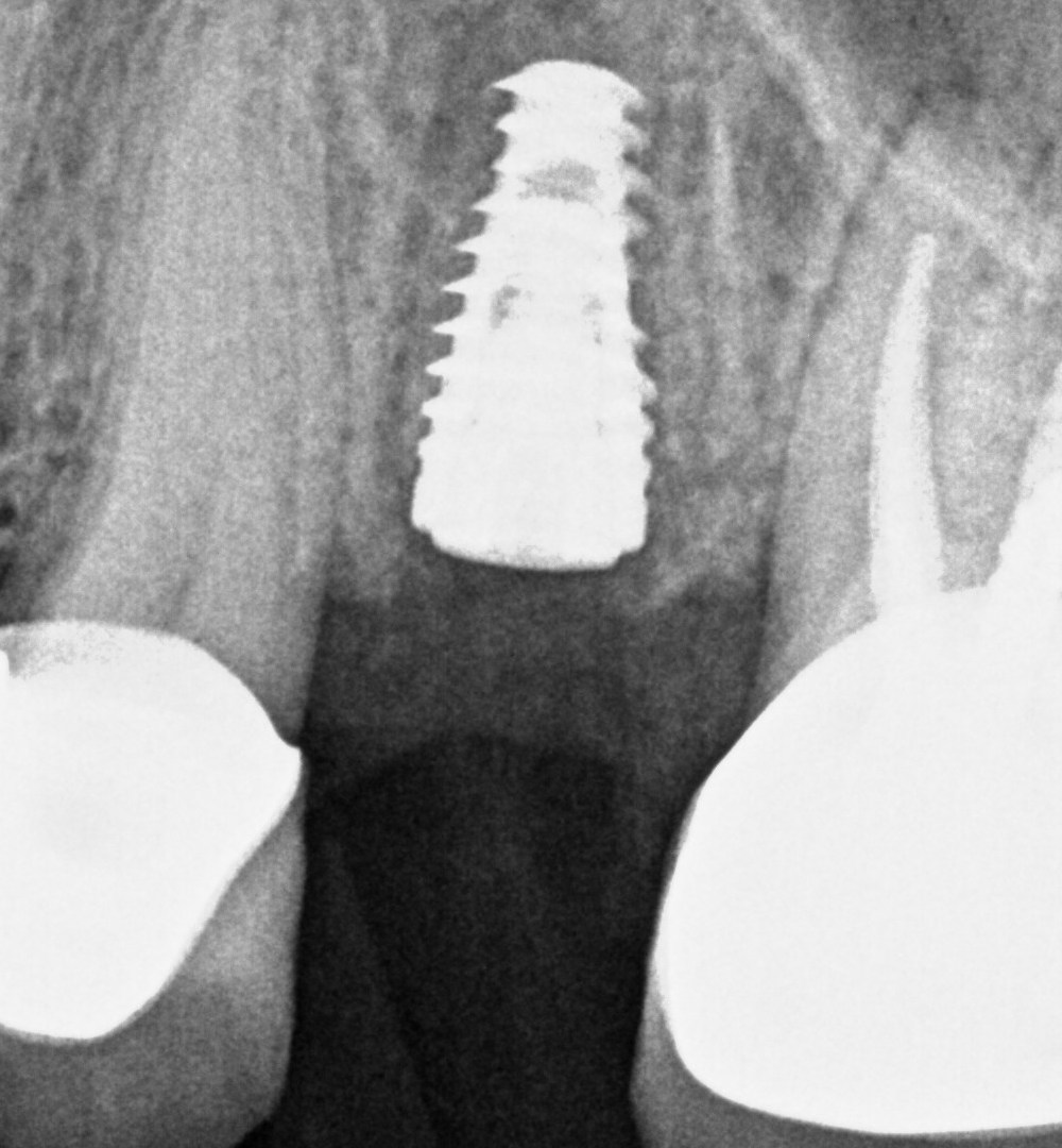 Dental x-rays of one patient: an implant at placement, and the same implant with its final crown.
