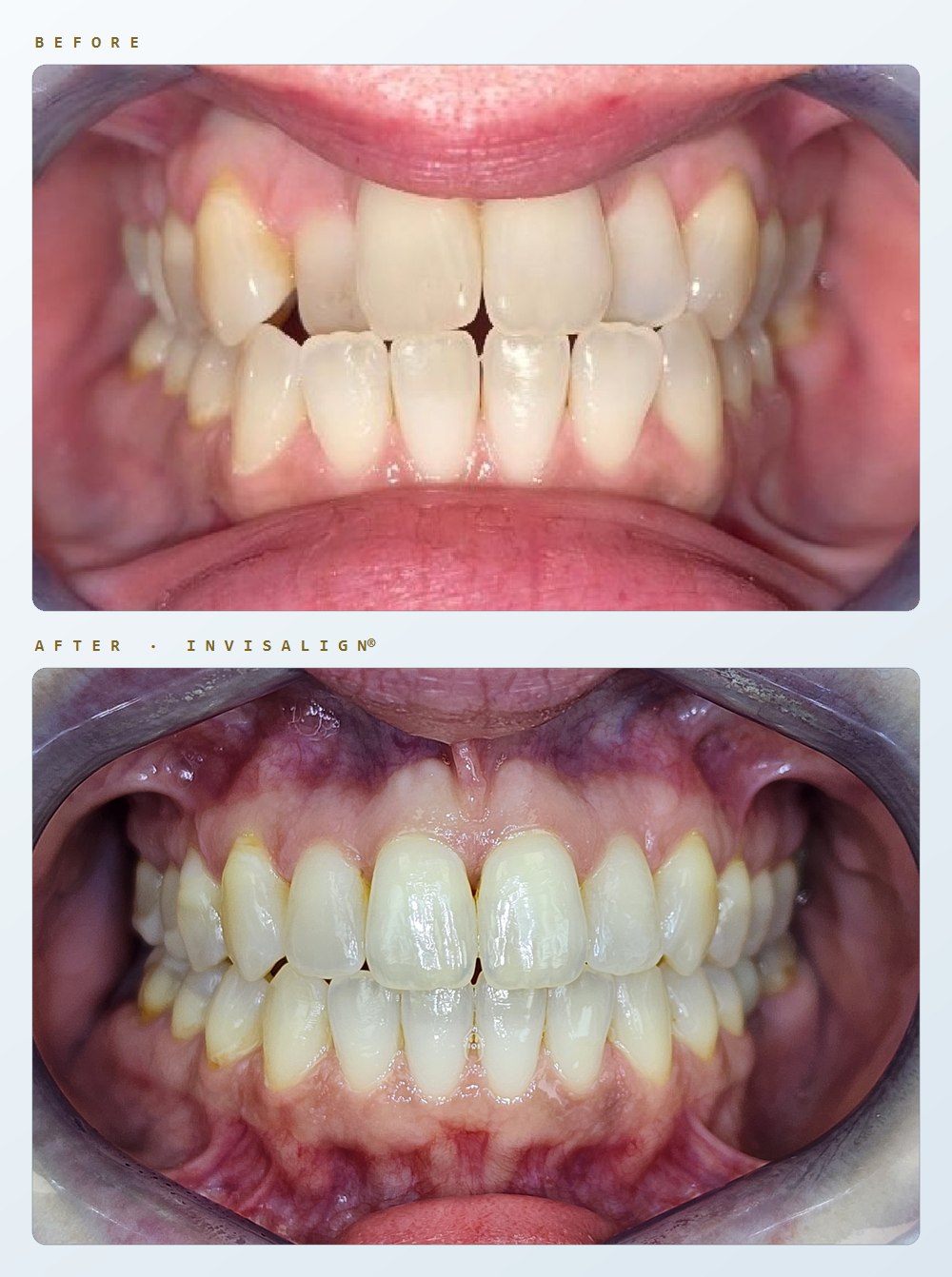 Before and after intraoral photographs of one patient treated with Invisalign by Dr. Oh. The upper photograph shows the front teeth meeting edge to edge with gaps between the incisal edges; the lower photograph shows the same teeth aligned, with the upper teeth overlapping the lower evenly.