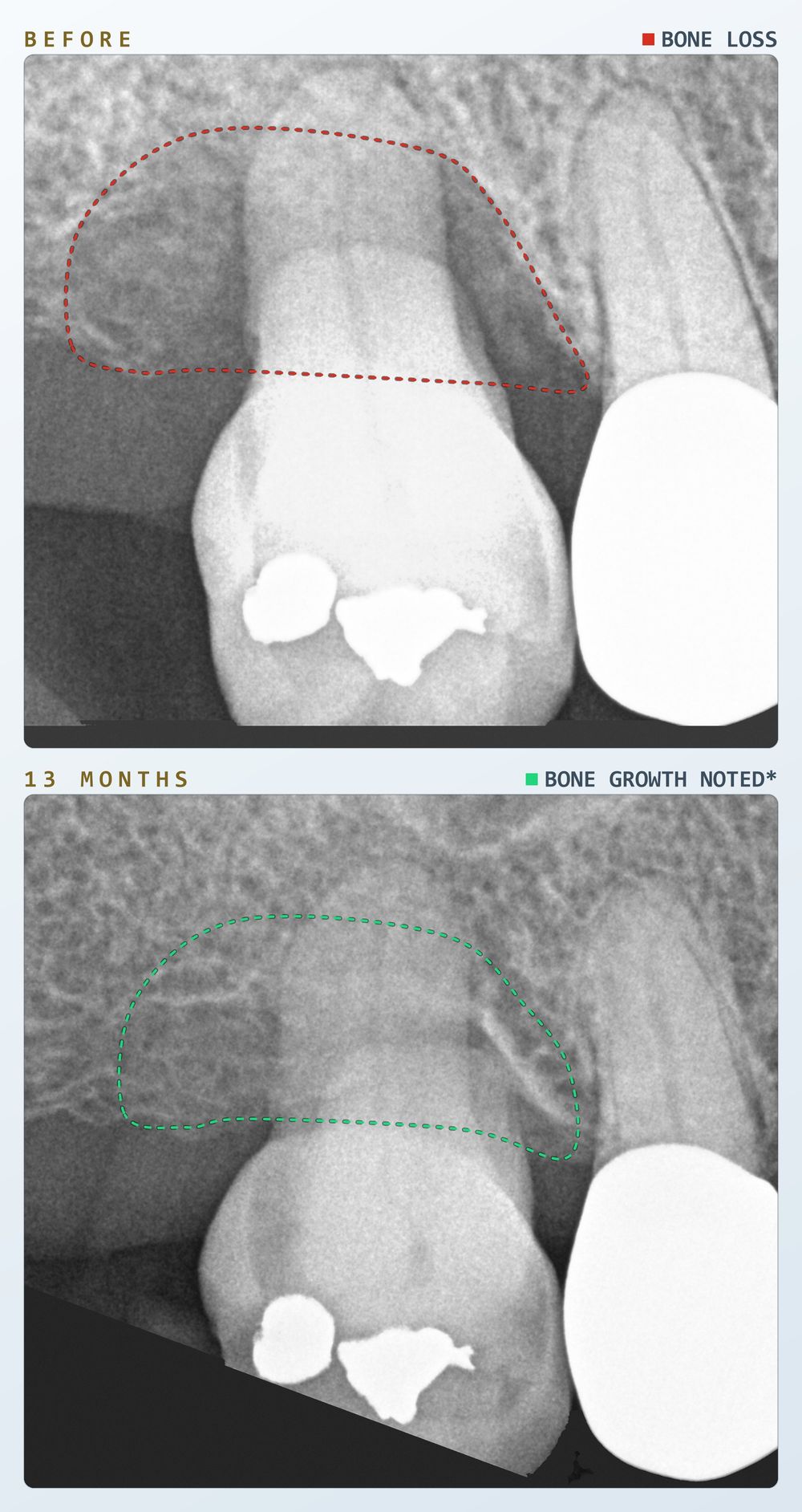 Two periapical radiographs of the upper right first molar in one patient, stacked vertically: before laser gum treatment and at thirteen months. A dashed red outline on the first film marks the area of bone loss; a dashed green outline on the second marks the same area at thirteen months.