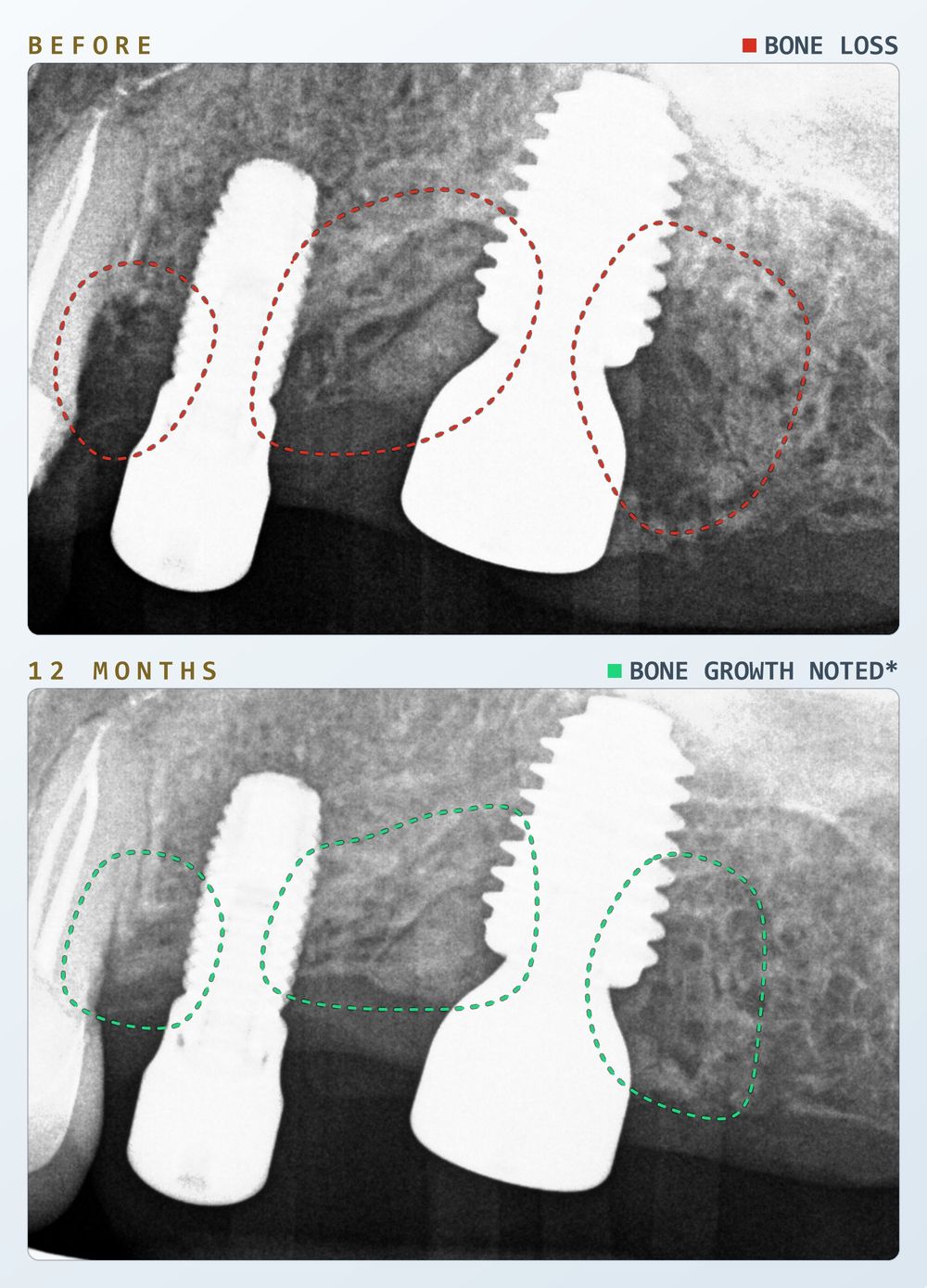 Two periapical radiographs of the same dental implant in one patient, stacked vertically: before laser treatment and at twelve months. Dashed outlines on the first film mark three areas of bone loss around the implant; dashed outlines on the second mark the same areas at twelve months.