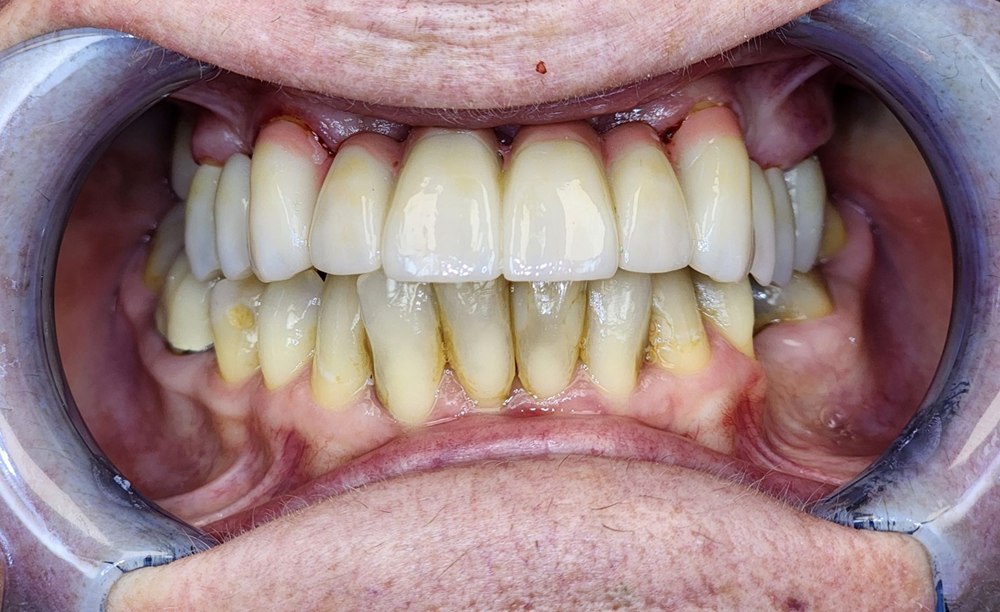 After treatment: the same patient's upper teeth restored as a continuous row of tooth-colored restorations, photographed with cheek retractors.