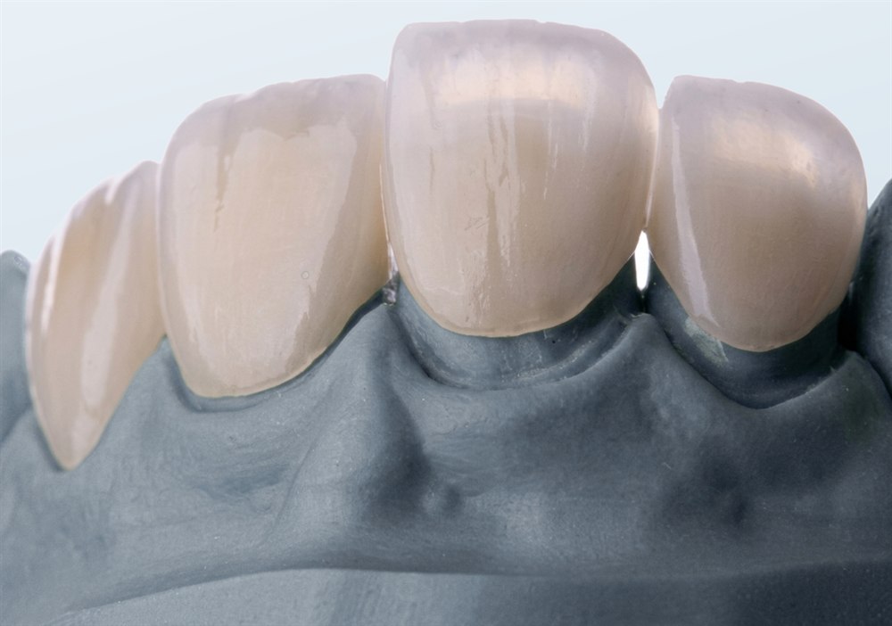 Four porcelain veneers seated on a slate-grey dental model, illustrating how thin a porcelain veneer is.